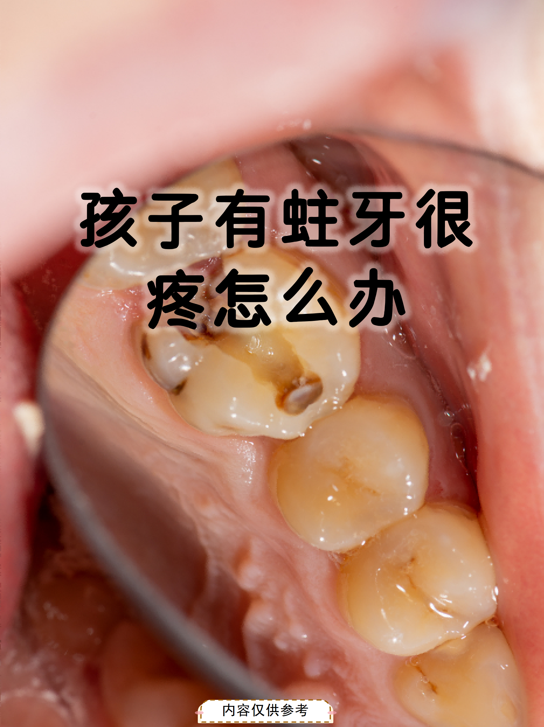 孩子蛀牙疼起来真是让家长揪心,其实这是牙齿