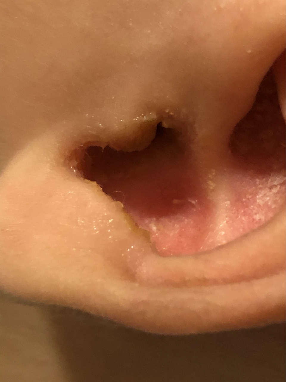 耳朵流黄水,发臭,睡觉摇晃,哭闹!中耳炎 我们家问题宝宝的问题又来了!