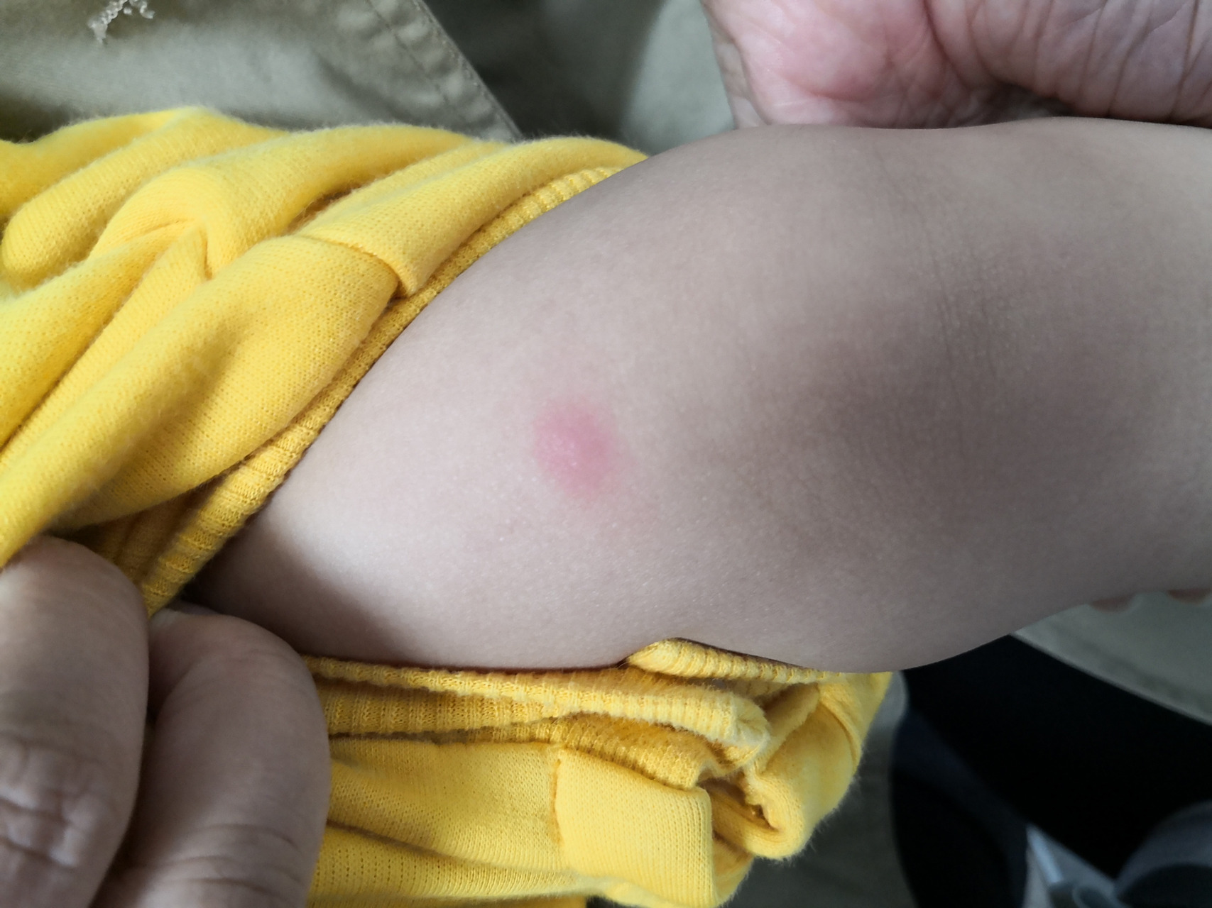 儿童丘疹性荨麻疹症状#过敏##解决皮肤问题专注皮肤美容##虫咬皮炎