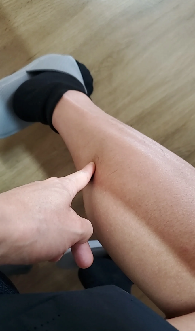 小腿抽筋最常见的原因有缺钙,受凉,出汗太多,运动过度或发烧