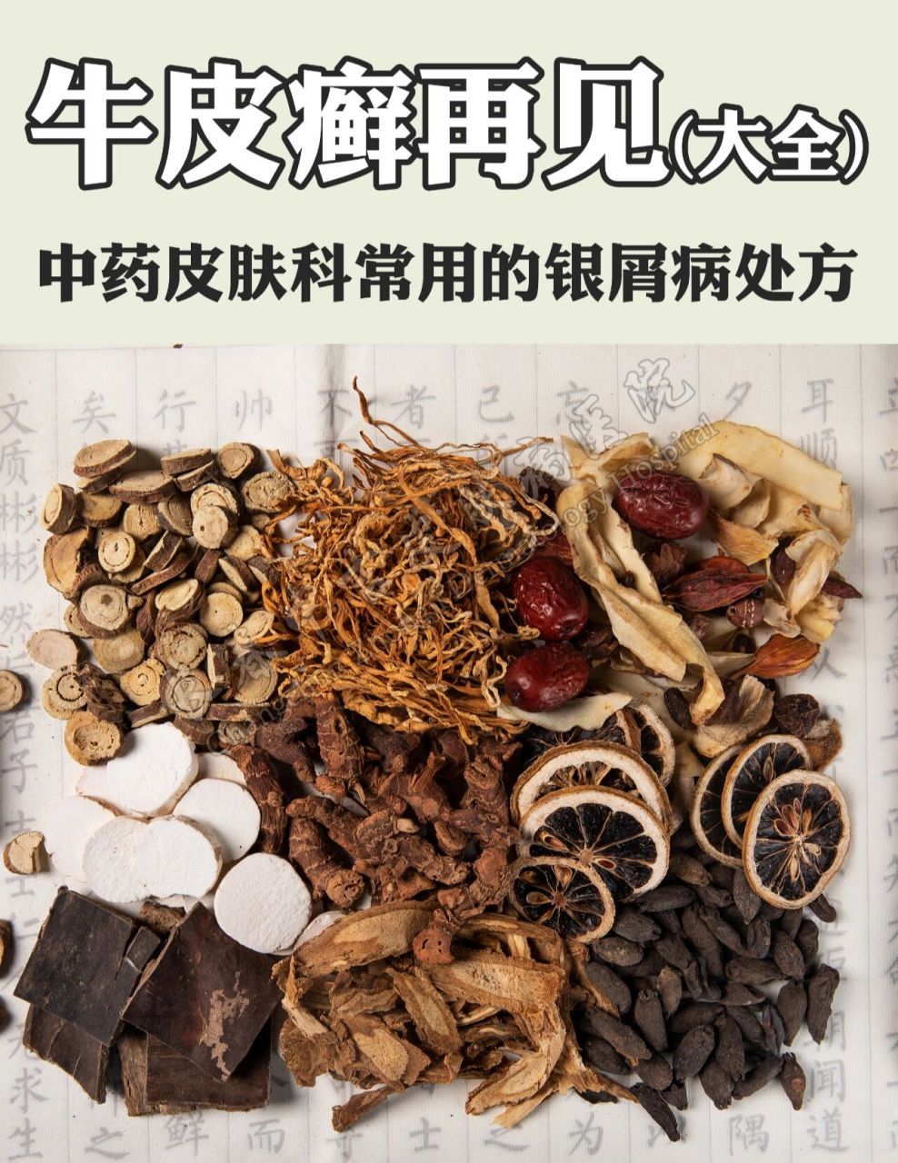 中药皮肤科常用的银屑病处方 寻常银屑病在银屑病类型当中是最常见的
