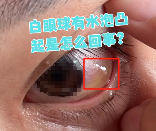 白眼球上出现水泡凸起,可能是结膜水肿,结膜淋巴管扩张,睑裂斑或
