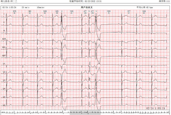 频发室早心电图图片