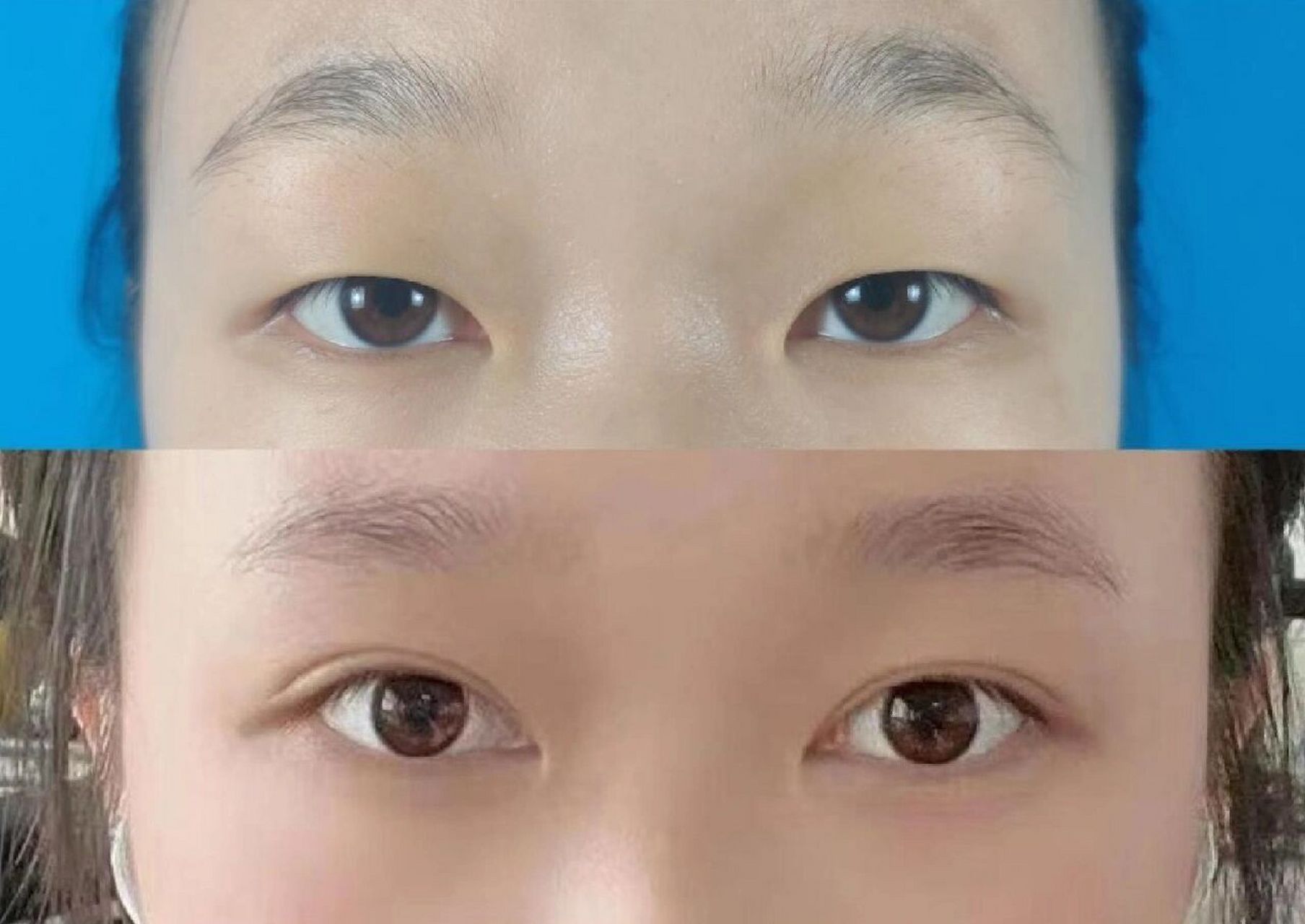 来来来,我的双眼皮前后对比图 说实话,我以为我的双眼皮手术会特别