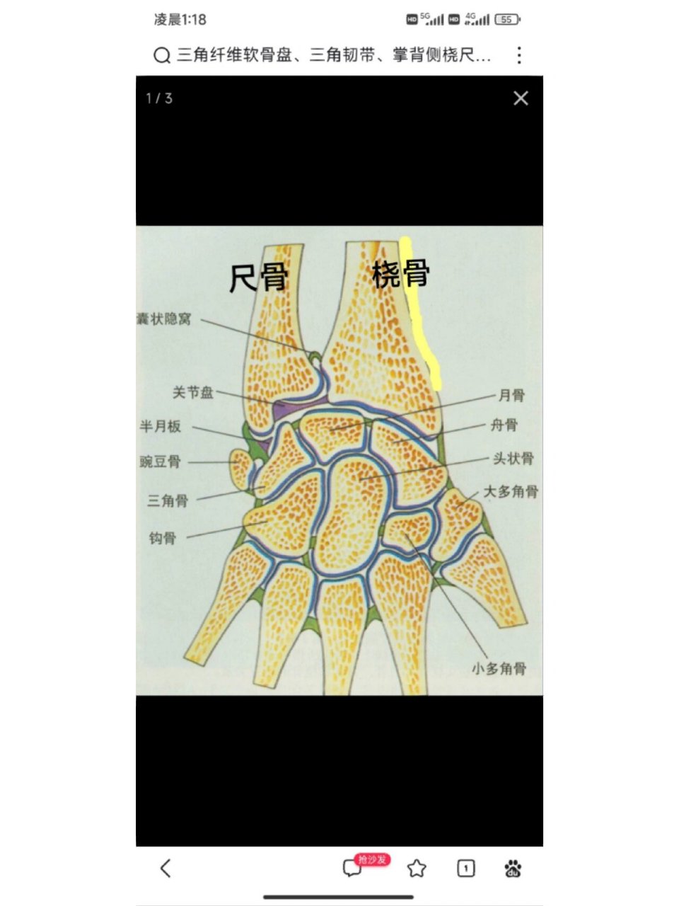 tfcc是指腕关节尺侧的一组重要的结构,包括关节盘,半月板同系物,掌侧