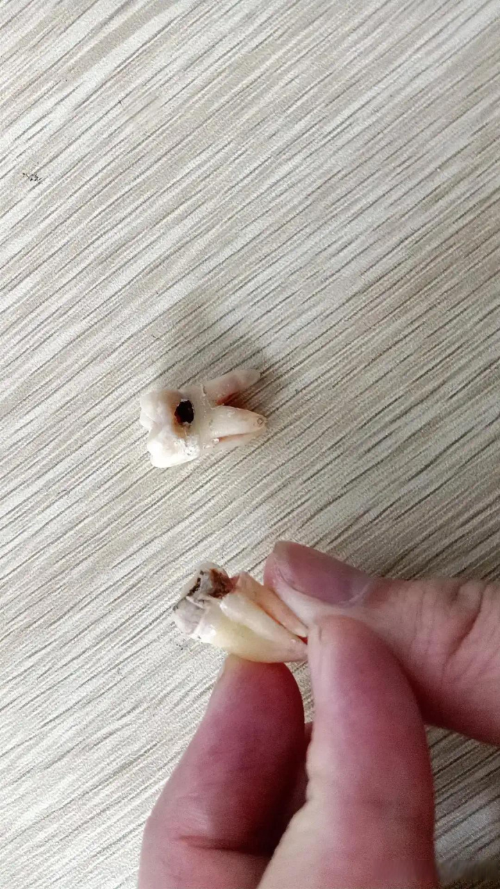 今天是拔牙的第三天.