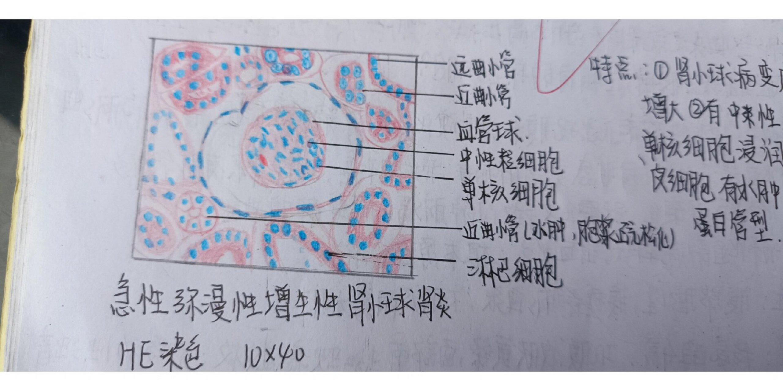 慢性肾炎红蓝铅笔绘图图片