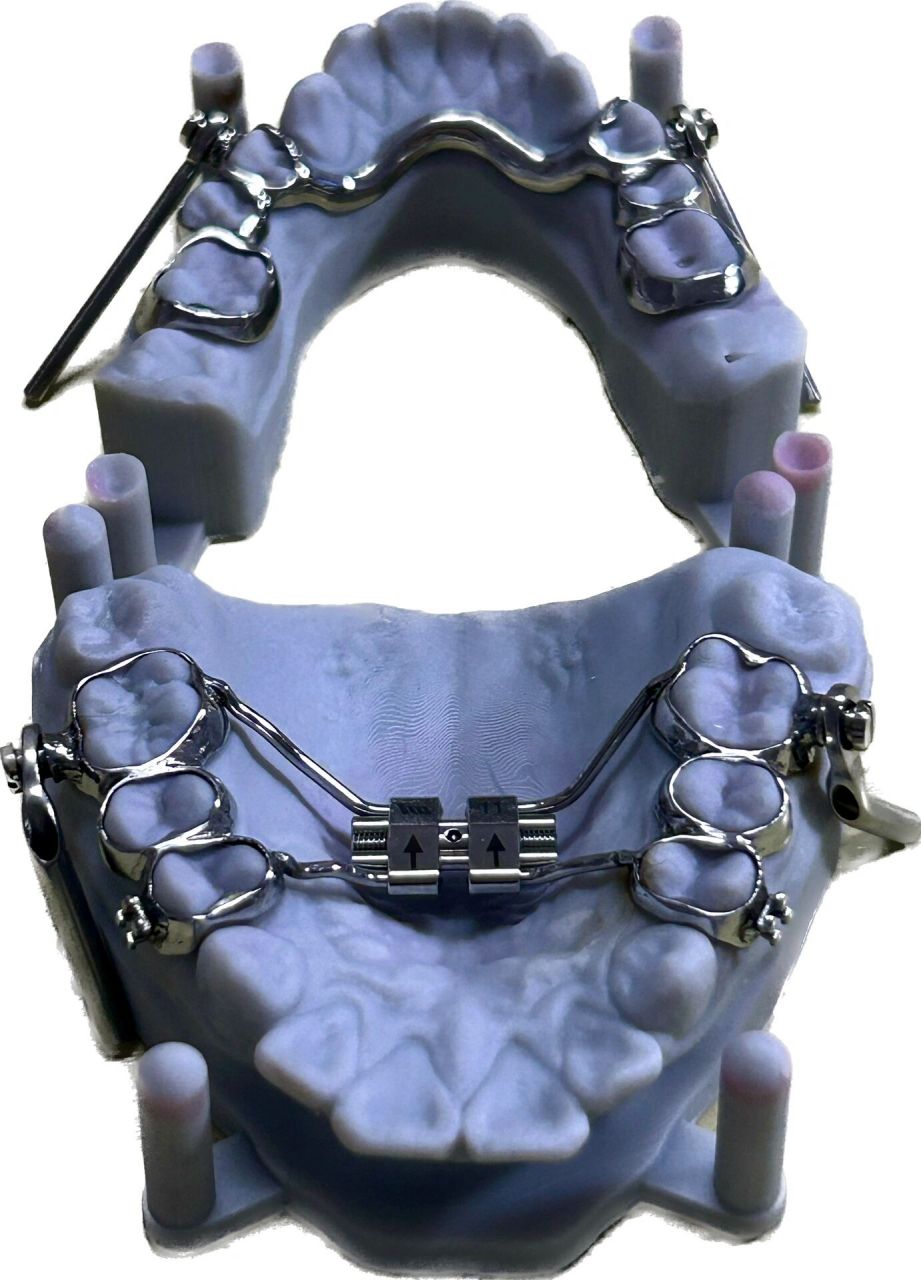 herbst 咬颌前移器(导下颌向前) herbst矫治器,是一种固定的功能性