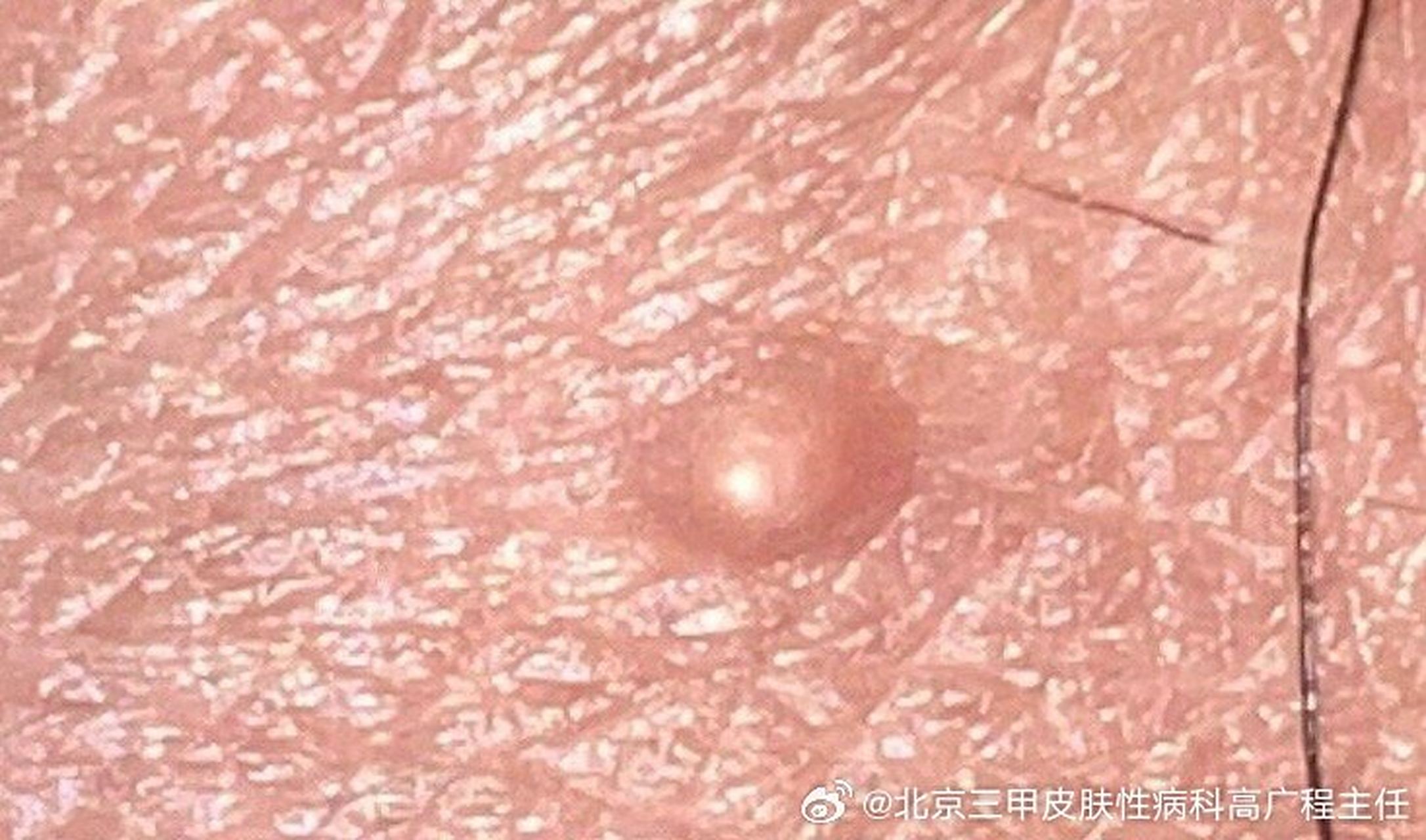 图片表现是皮脂腺增生,不是