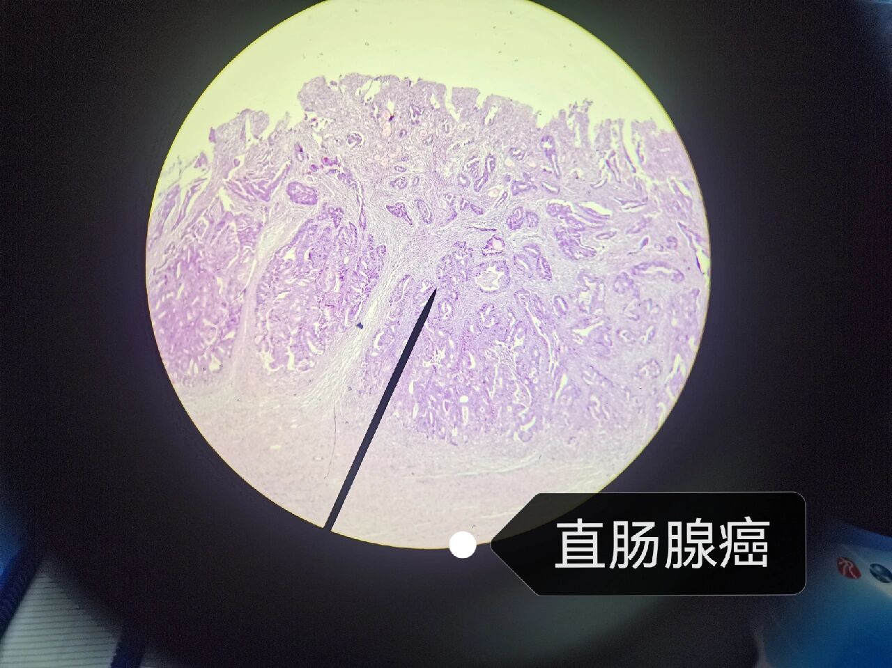 直肠腺癌切片图图片