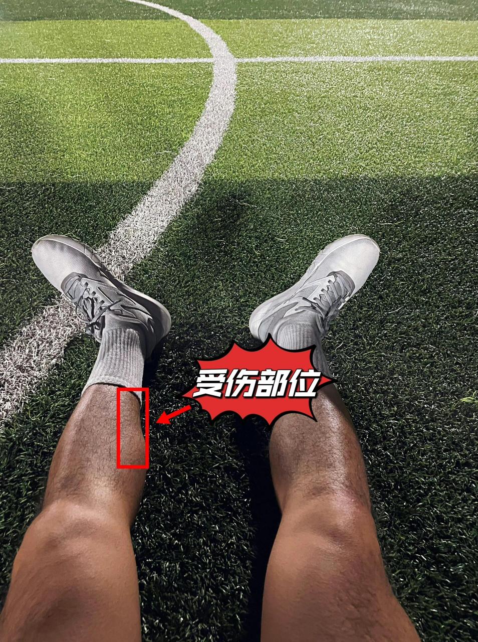 小腿肌肉拉伤恢复记录 距离上周五受伤至今,刚好一周时间,从脚掌不敢