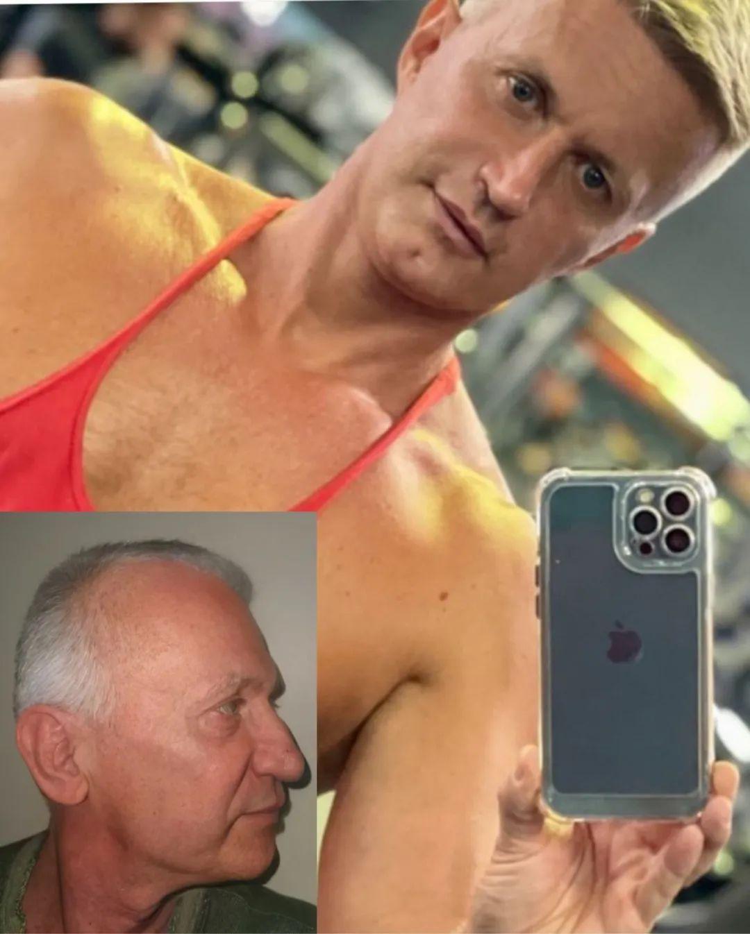 一位60岁的大叔在接受了面部提升,颈部提升,上下眼睑手术,植发和鼻