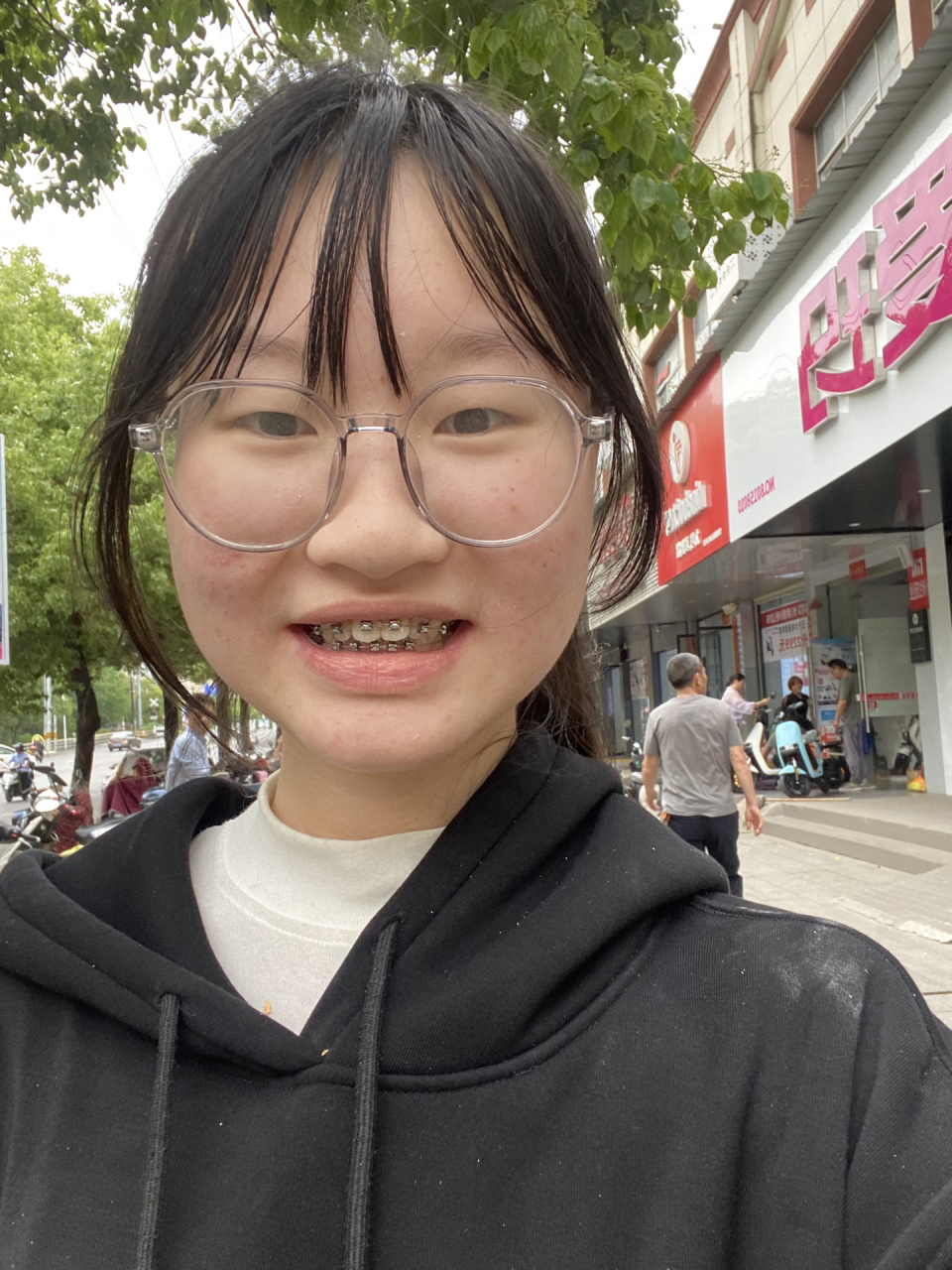 拔四颗牙齿会影响脸型吗?