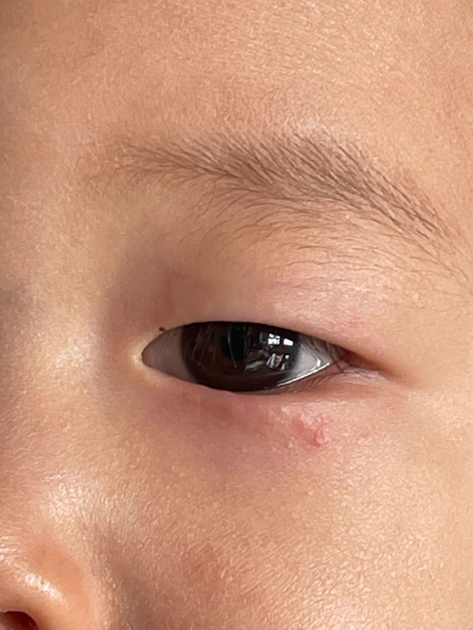宝宝眼角长了小疙瘩是为啥 刚开始只是有小白点的痘痘,类似粉刺 就