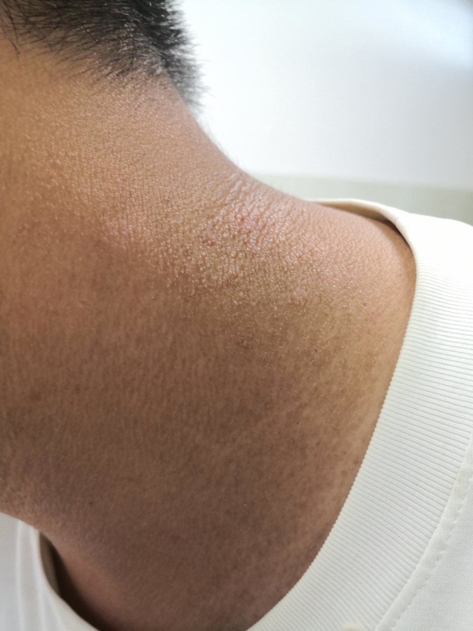 考虑日光性皮炎症状和神经性皮炎症状#解决皮肤问题专注皮肤美容