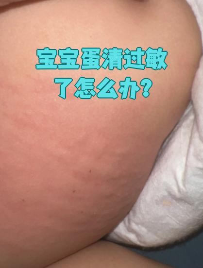 宝宝如果对蛋清过敏,首先要立刻停止吃蛋清