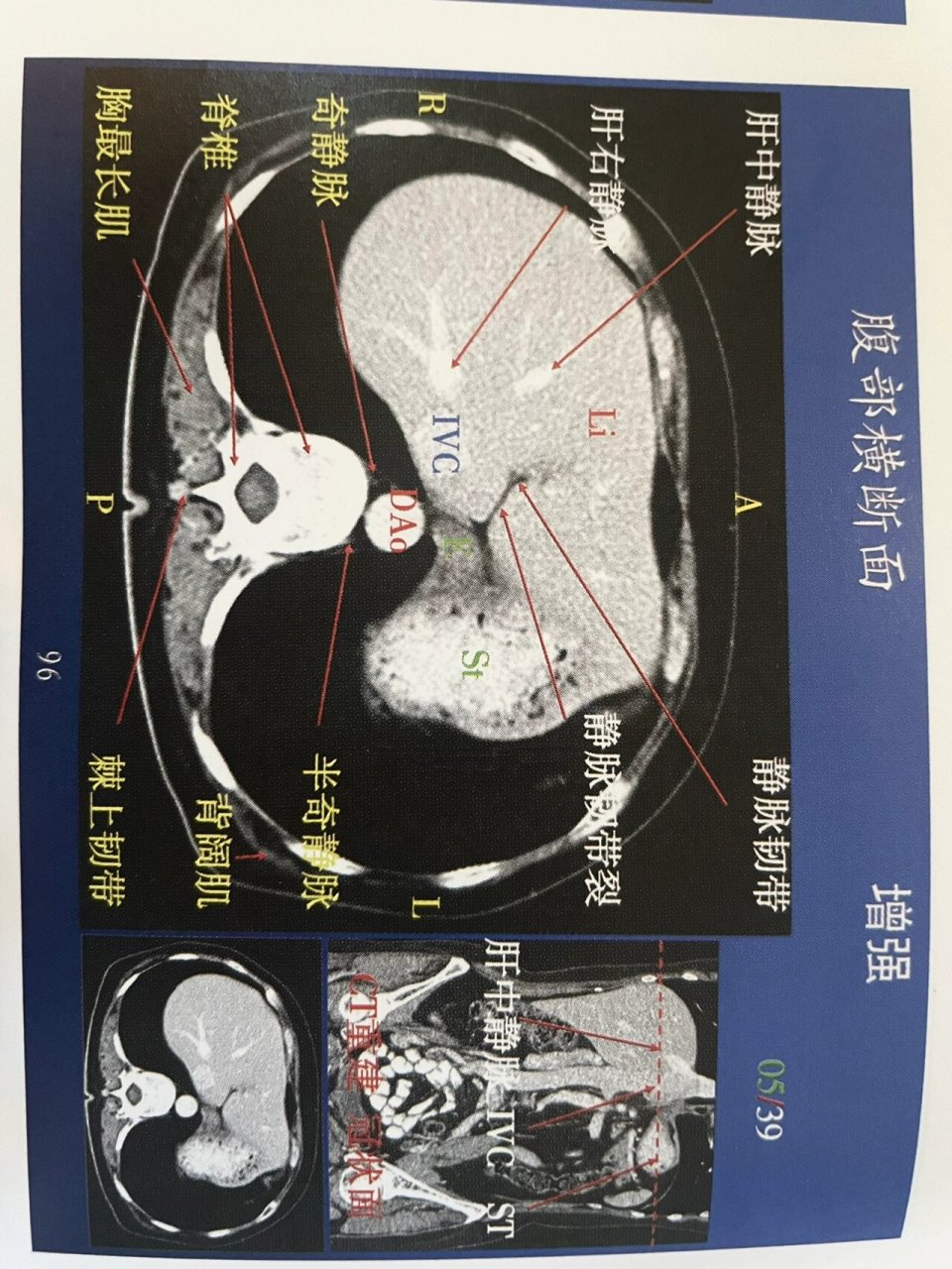 肝脏ct增强解剖!上腹部 肝脏详细横断面解剖图!