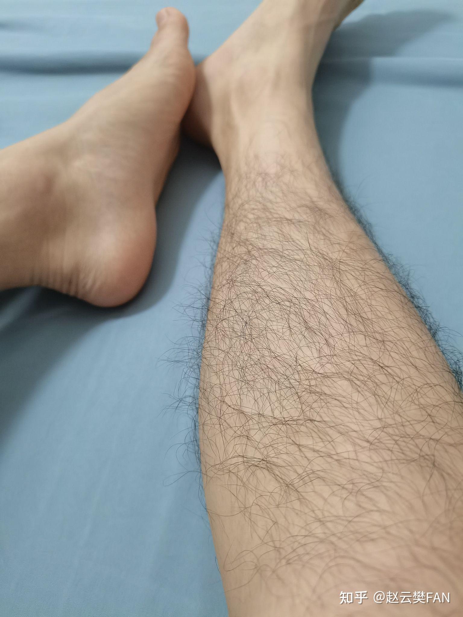 腿毛真的会越刮越多吗