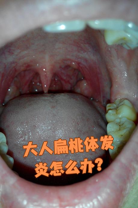 为什么会扁桃体发炎