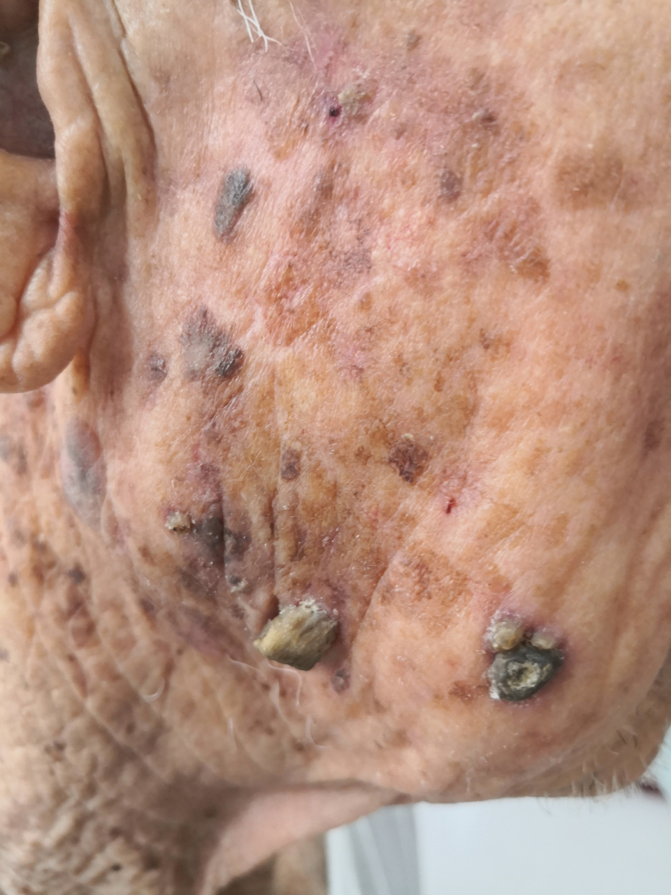 78岁老年男性面部皮角症状并发弥漫性老年斑/脂溢性角化.