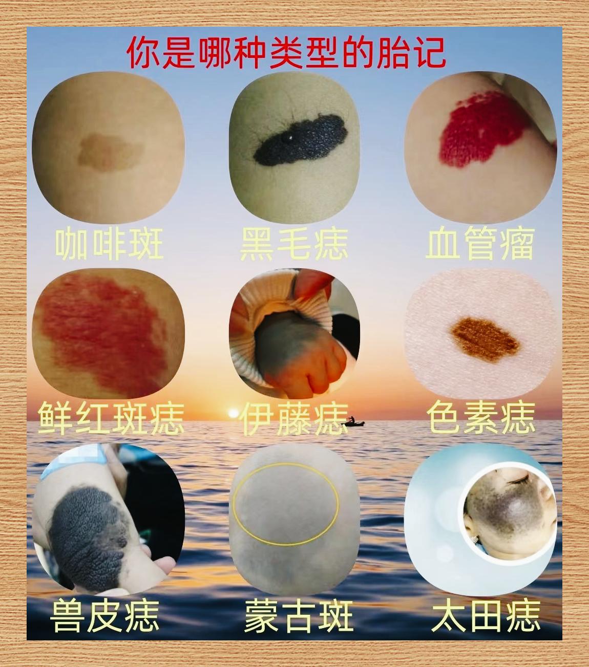 胎记位置寓意图