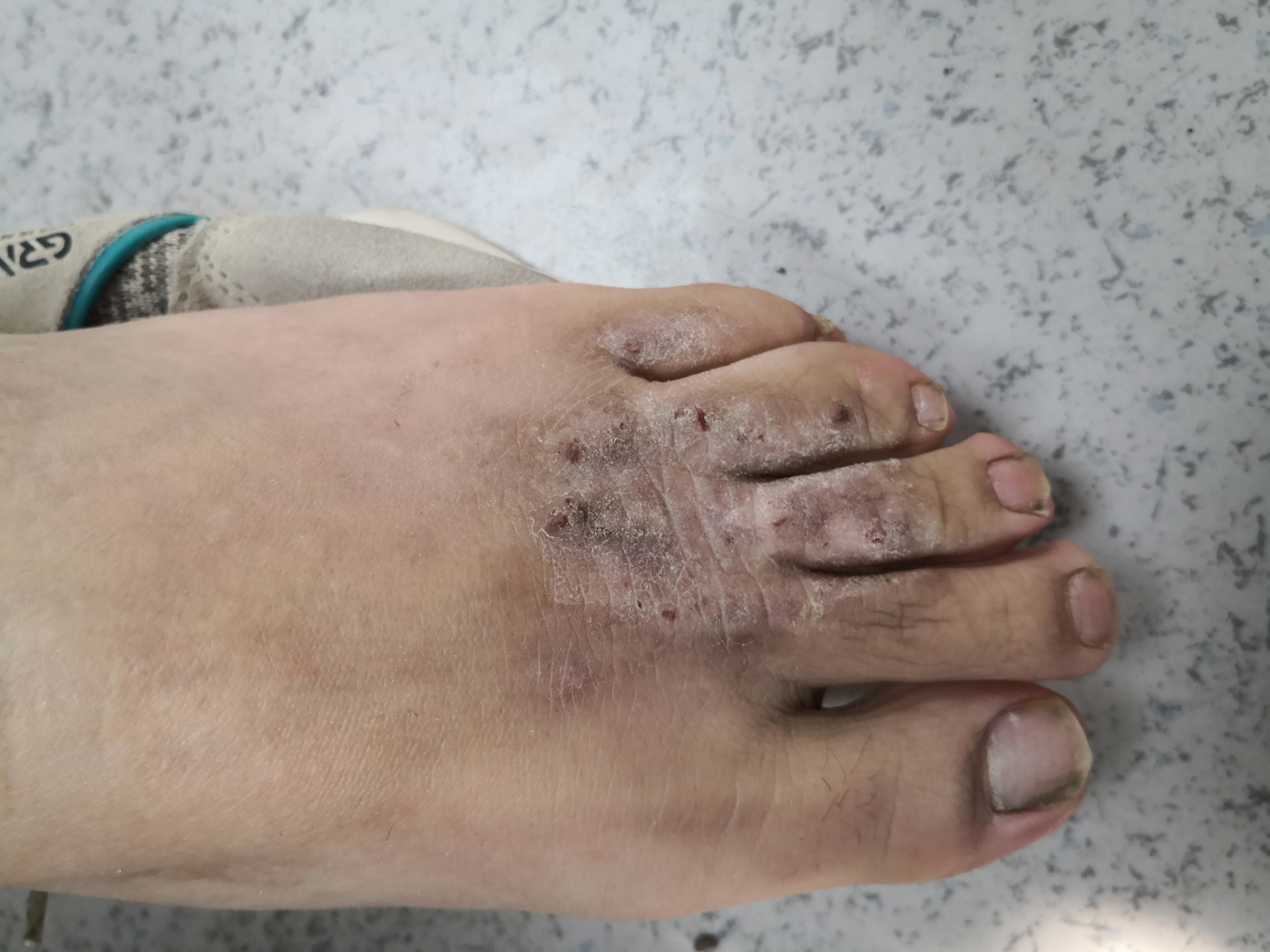 足背和阴囊神经性皮炎的症状.#神经性皮炎