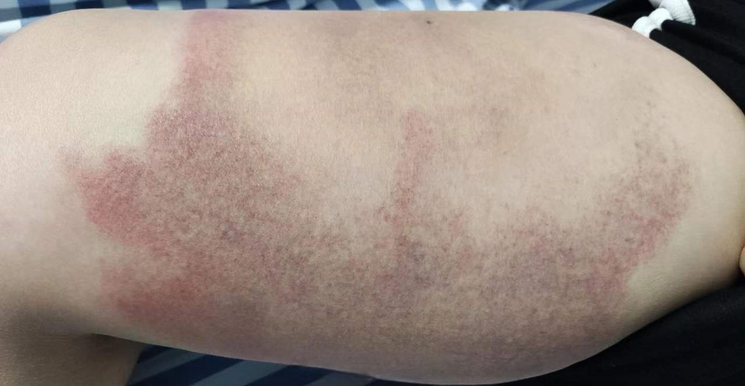 【女子被蜘蛛咬后肿了半条大腿 ,医生:被咬后这样正确处理】随着盛夏