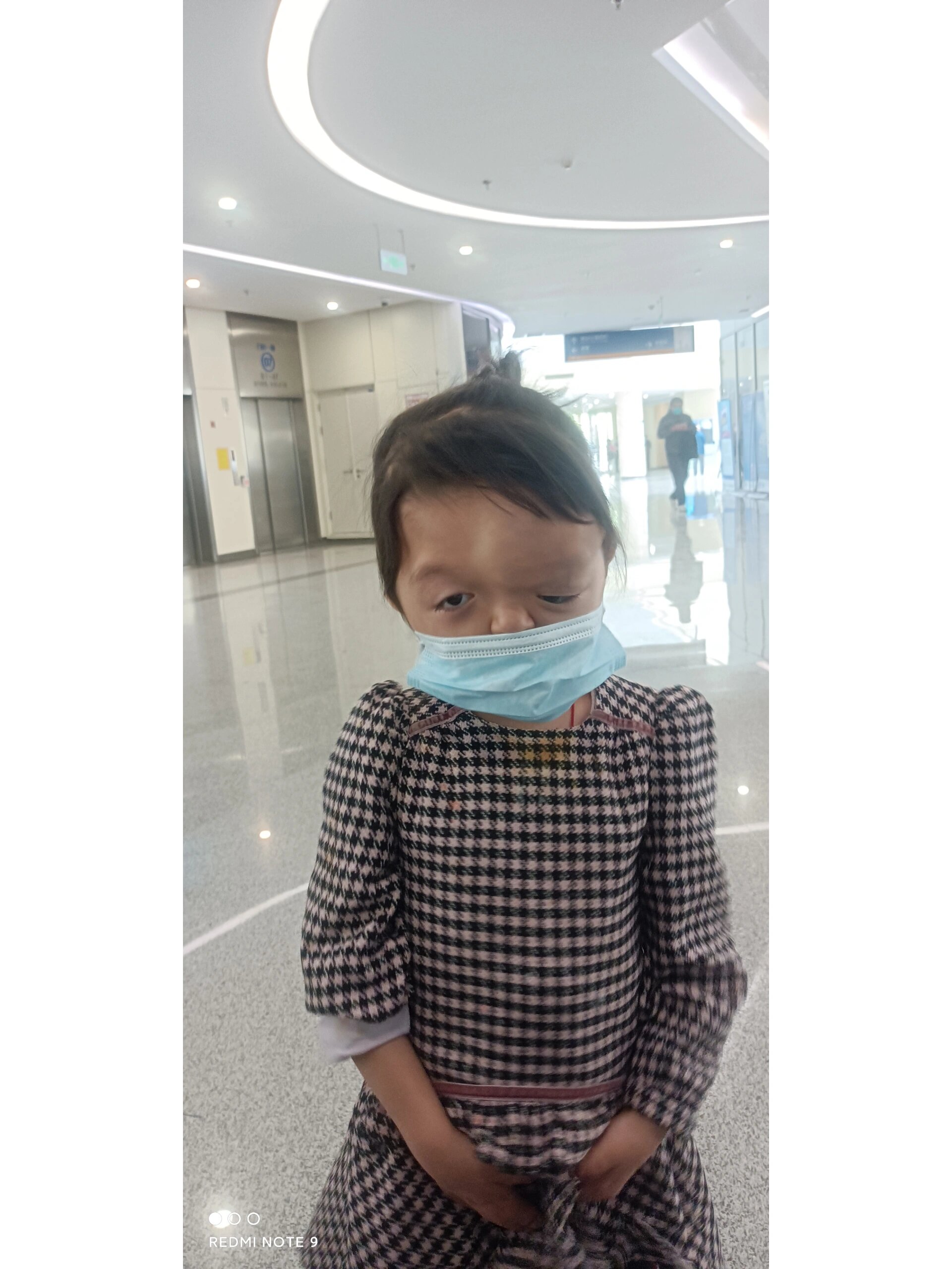 apert阿佩尔氏综合症颅缝早闭 闺女,19年8月查出脑积水,双侧冠状颅缝