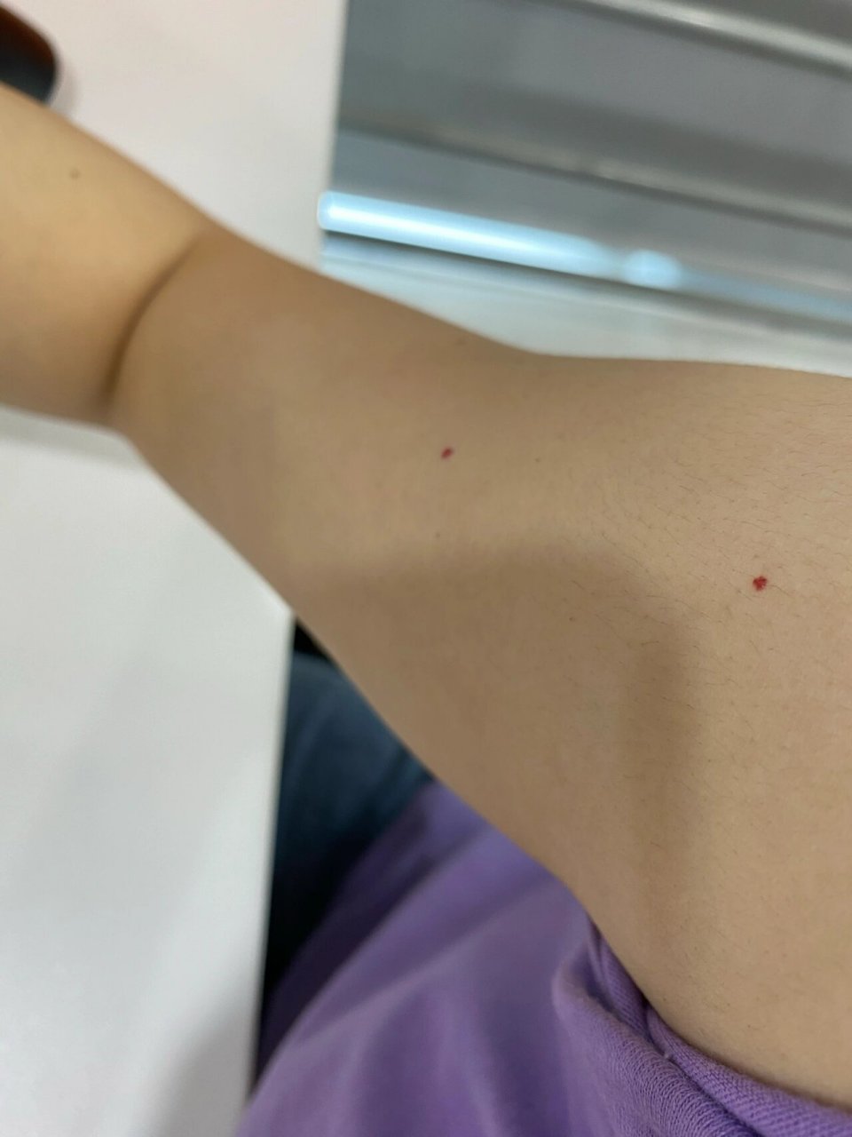 红痣 两个手臂上都张了红痣,一直没管他,什么鬼啊 后背也有2个