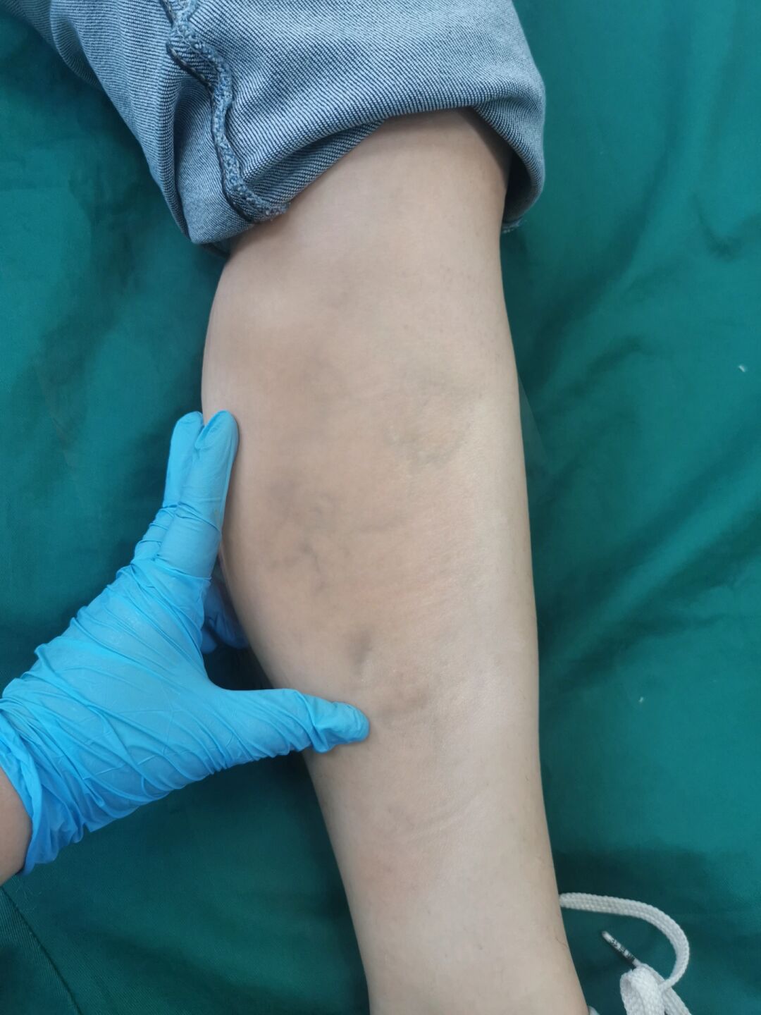 我是腿部开始疼的时候,才发现自己小腿上血管明显的吓人,去看过之后