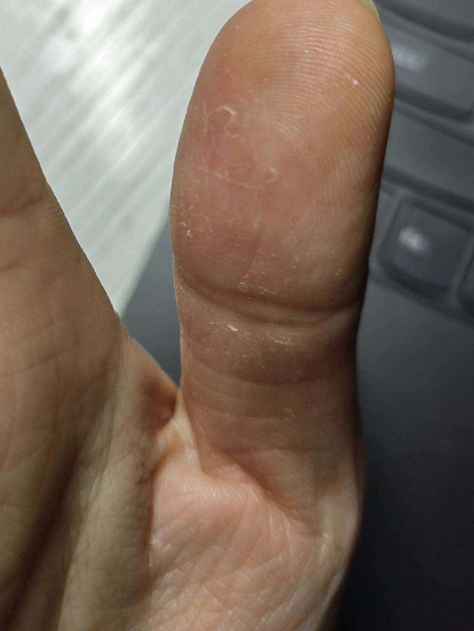 手指脱皮了几个月了 大拇指指纹都没了,今天开始吃维生素看没有用