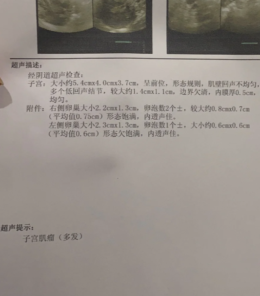 主要是为了检查子宫大小,形态,回声泅况