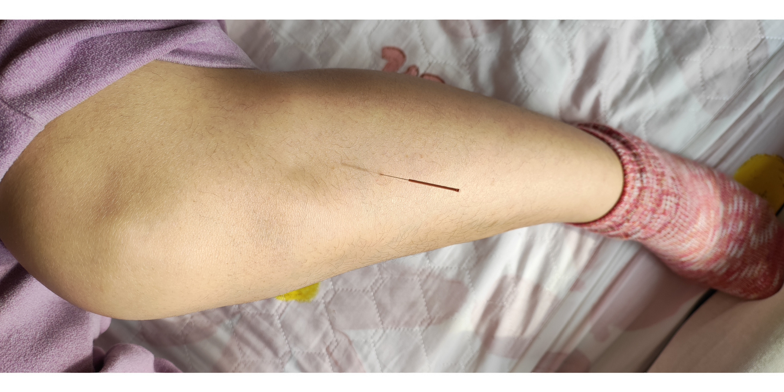 针灸第三针,足三里——治百病 现在学出毛病了,听着听着瘾一上来就想