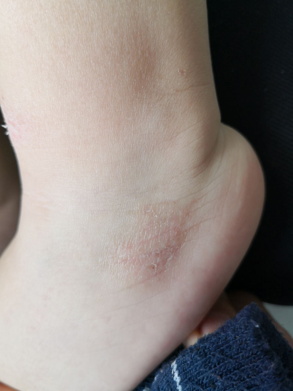 儿童足部红斑丘疹脱屑症状考虑特应性皮炎的诊断