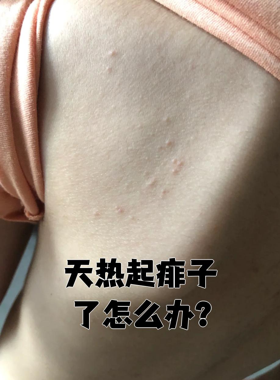 天热起痱子别着急,先用温水清洗皮肤,再涂炉甘石洗剂就能缓解