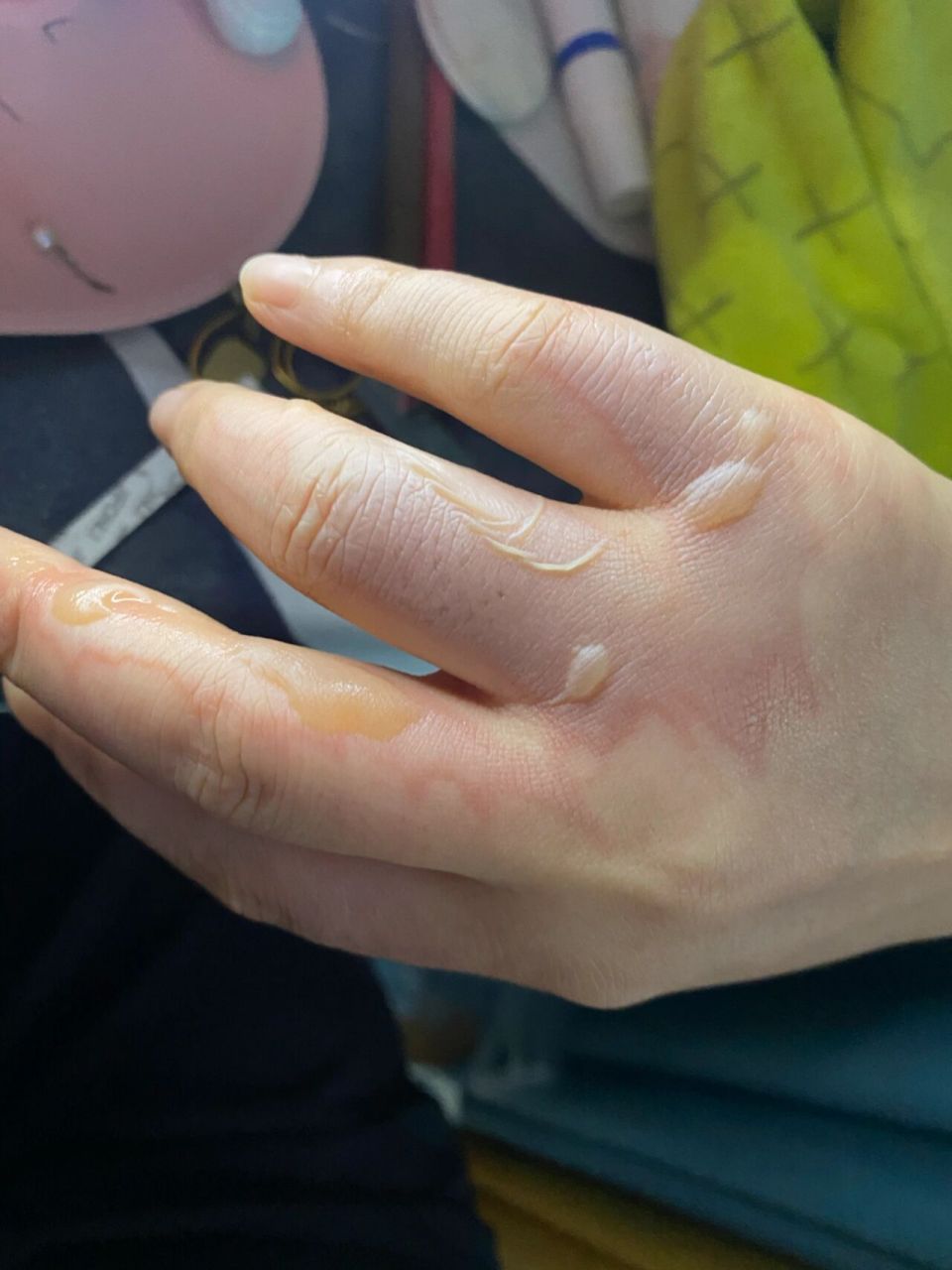 关于烫伤 昨天被油溅到烫了一大块,真心疼.不知道会不会留疤.