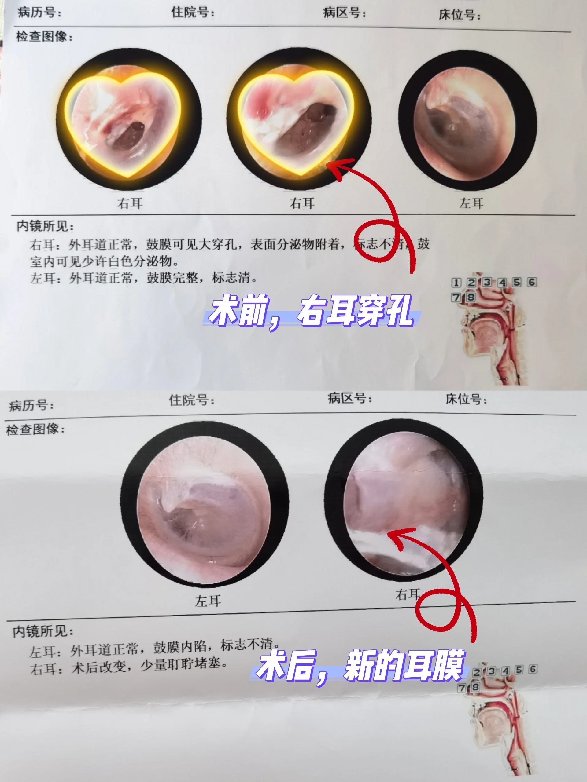 耳膜穿孔结痂图片图片