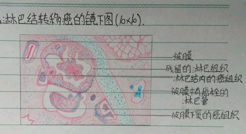 病理/淋巴结转移癌/手绘图