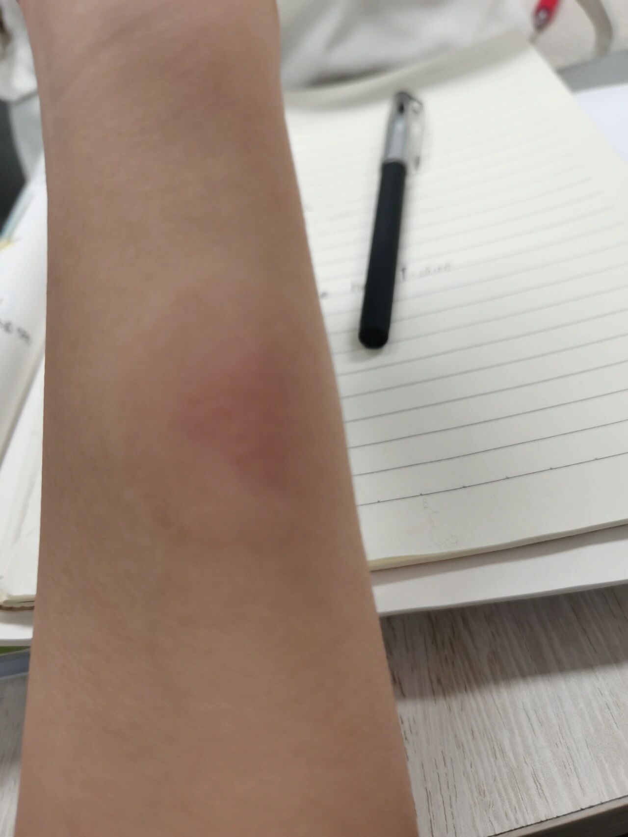 姐妹们有得过肺结核然后做ppd是强阳性的吗?