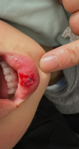 孩子嘴唇磕破后没有快速恢复的偏方,必须去医院处理