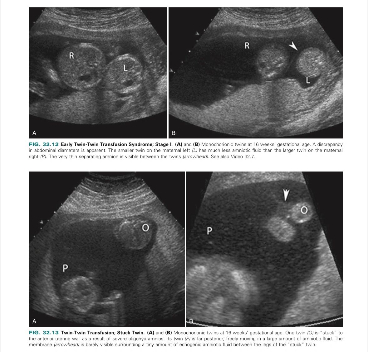 双胎输血综合征产前超声诊断 16615单线毛膜双羊膜囊双胎(同性别