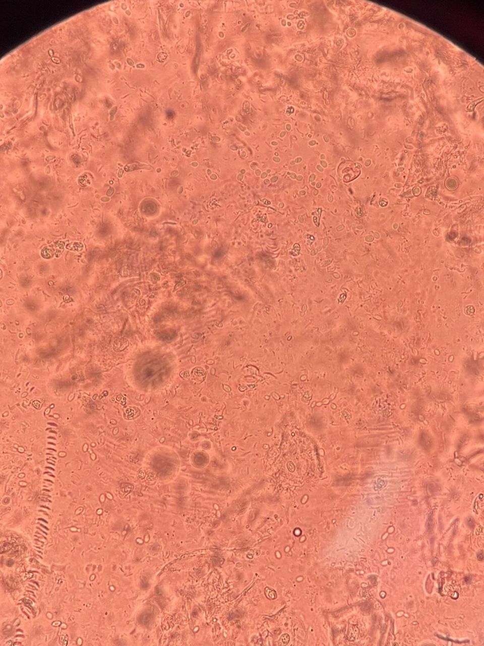 霉菌孢子显微镜94图 霉菌性阴道炎是我国妇科门诊最常见的阴道炎症