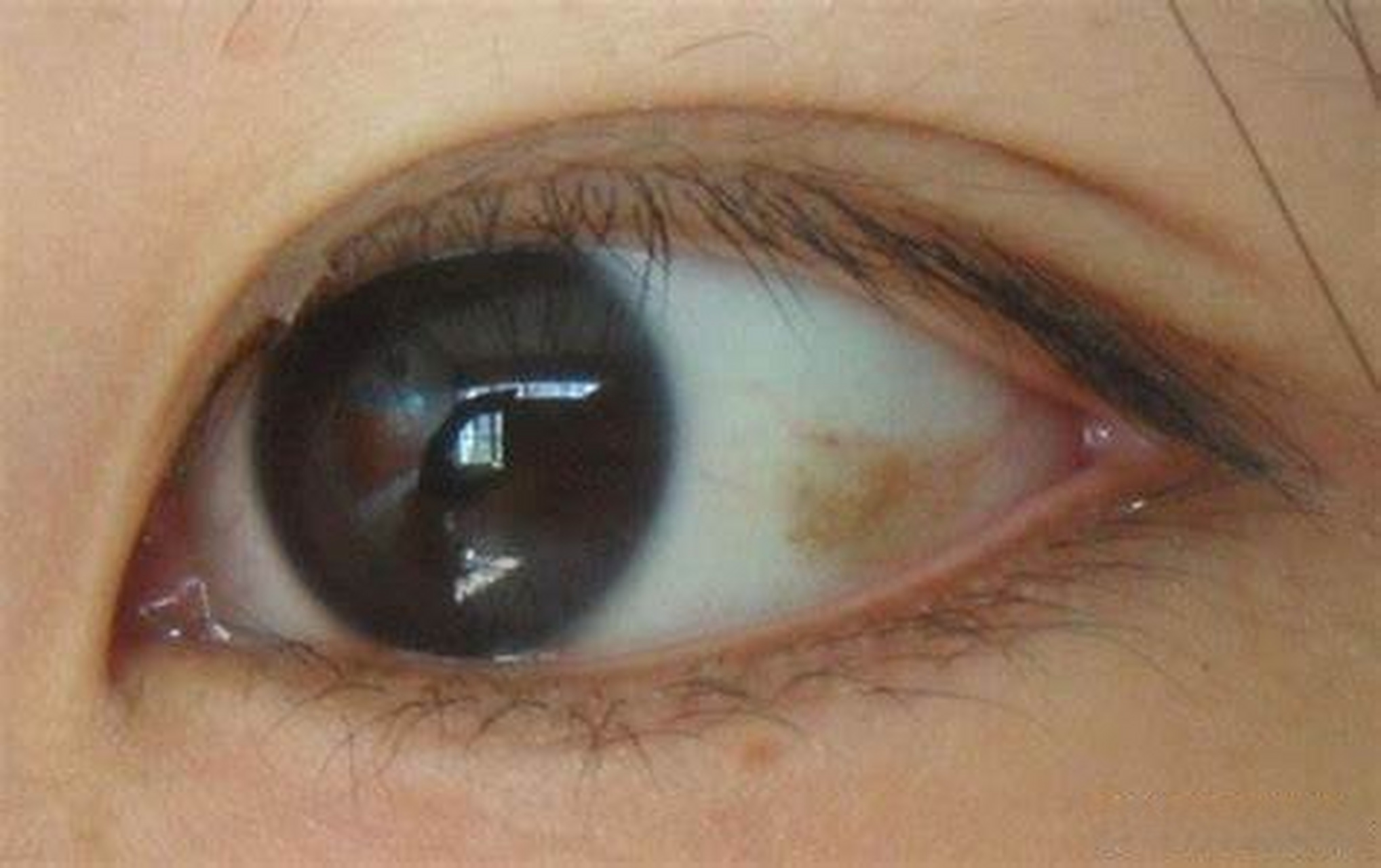 严重眼睑裂斑图片图片