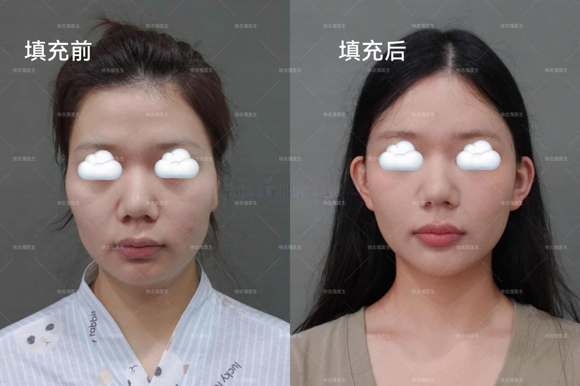 自体脂肪面部填充,术后1年 填充部位:额头,太阳穴,泪沟,颧沟,鼻基底