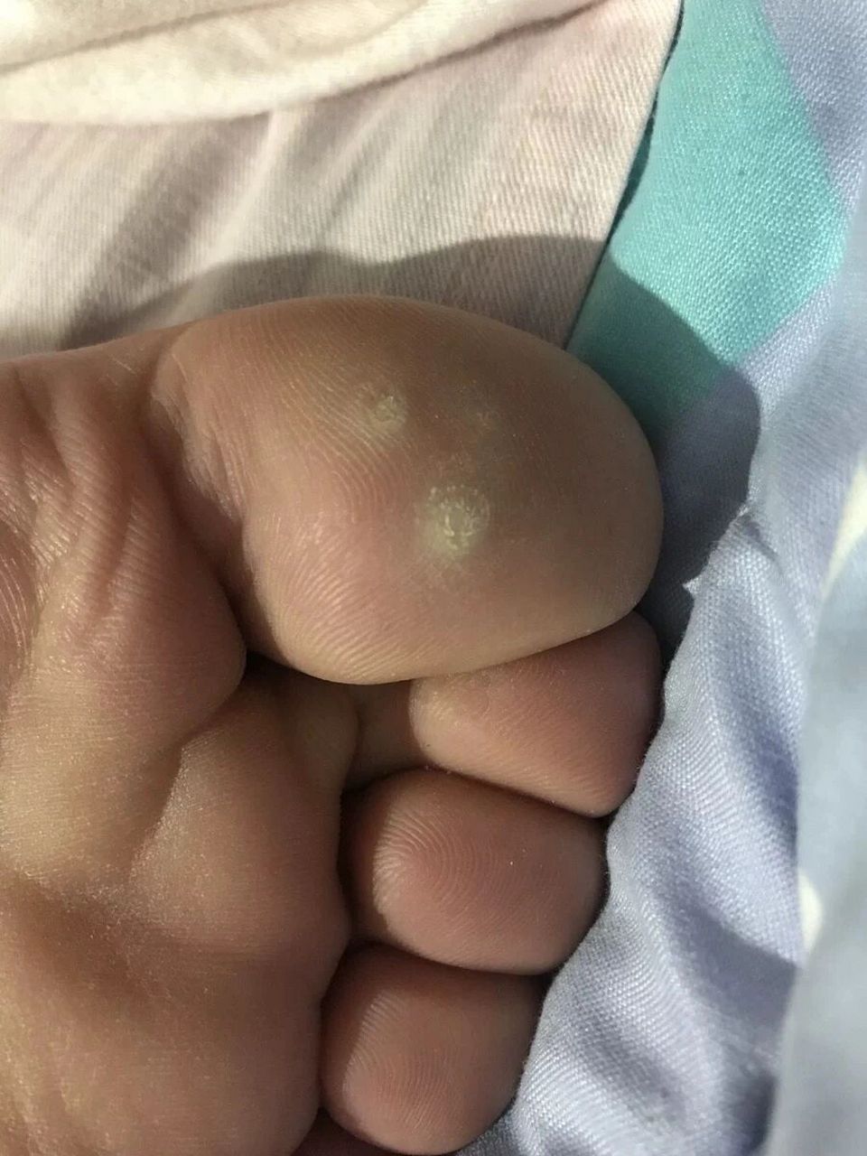 鸡眼比较严重一只脚脚趾头七八个,脚后跟都有,还有脚心已经开始走路