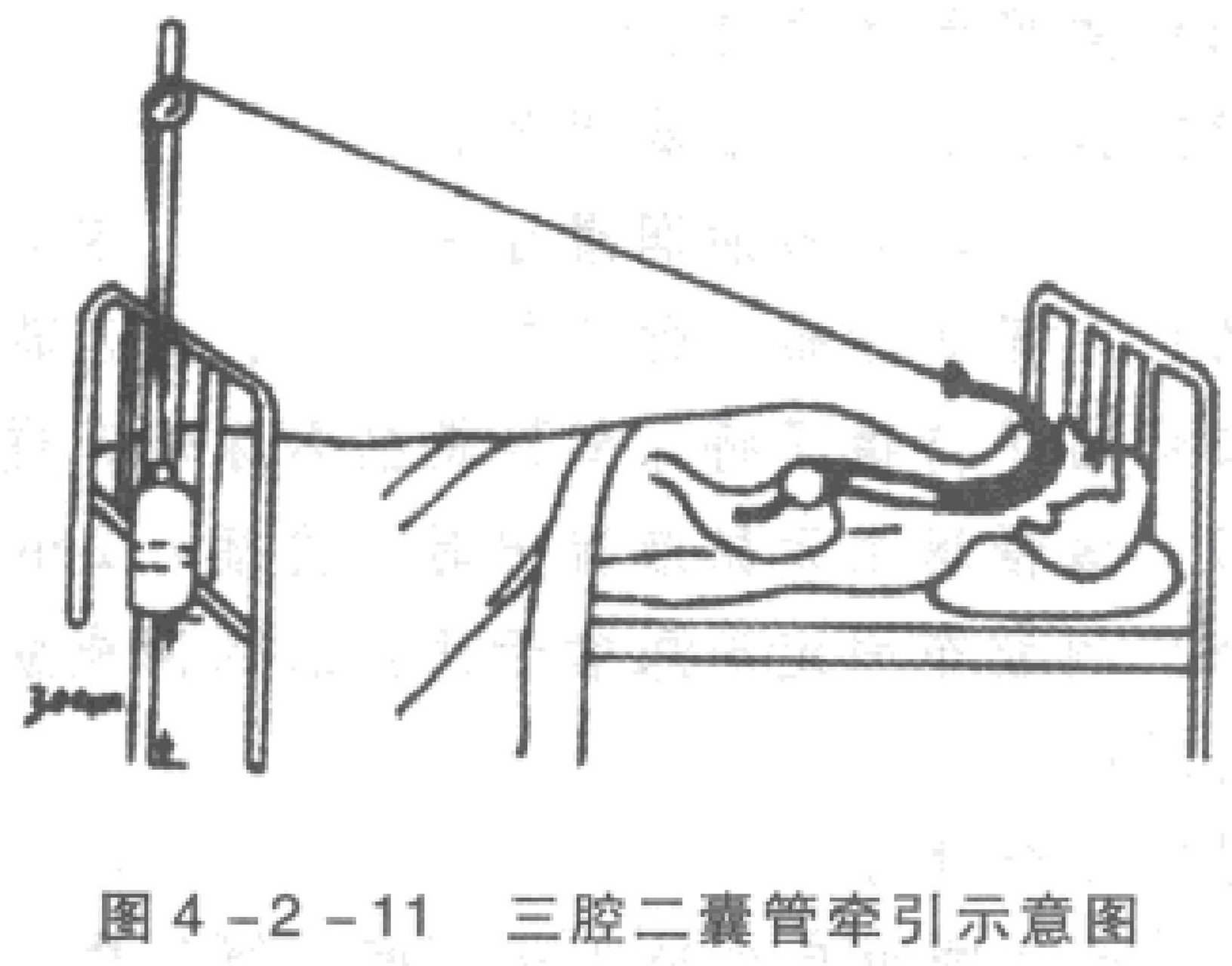 三腔二囊管胃管注气图片