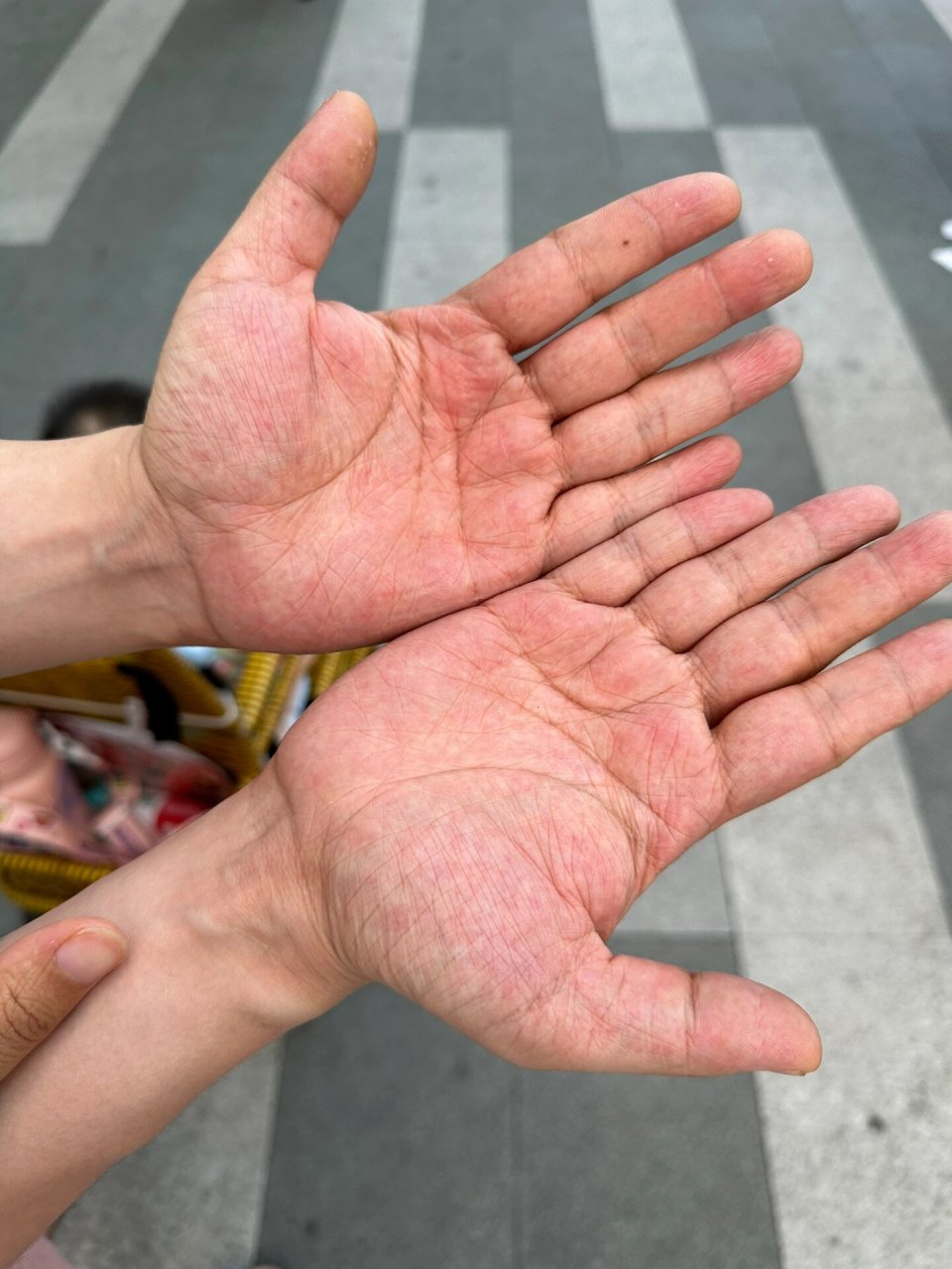 手掌很红是个什么情况 第一二张图是老公的,不知道为什么很红,第三张