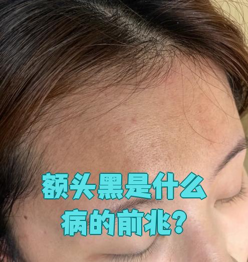 额头颜色变黑不一定代表生病.可能是熬夜或者日晒引起的