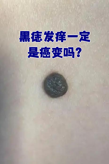痣为什么会越来越多