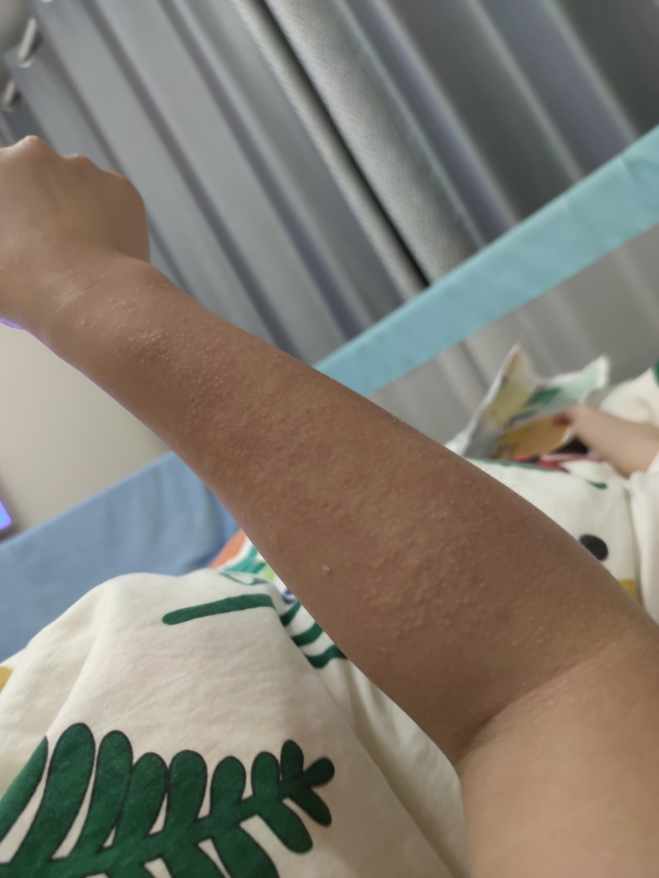 紫外线过敏怎么办 今天就在外面呆了一个小时胳膊就这样了,奇痒无比